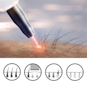 Il laser o fotodepilazione elimina i peli in modo sicuro lasciando la pelle morbida