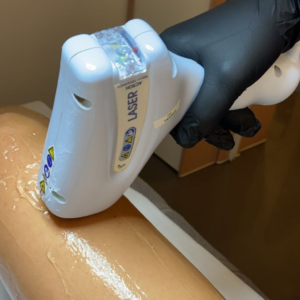 Il laser o fotodepilazione elimina i peli in modo sicuro lasciando la pelle morbida